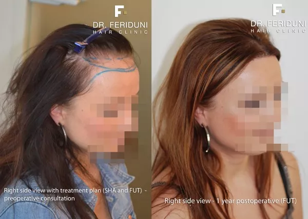 Haartransplantation für Frauen, Beispiel hohe Stirn Frauen - 1