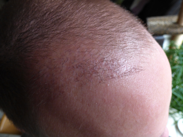 Misslungene Haartransplantation Marcel-k-empfangsgebiet