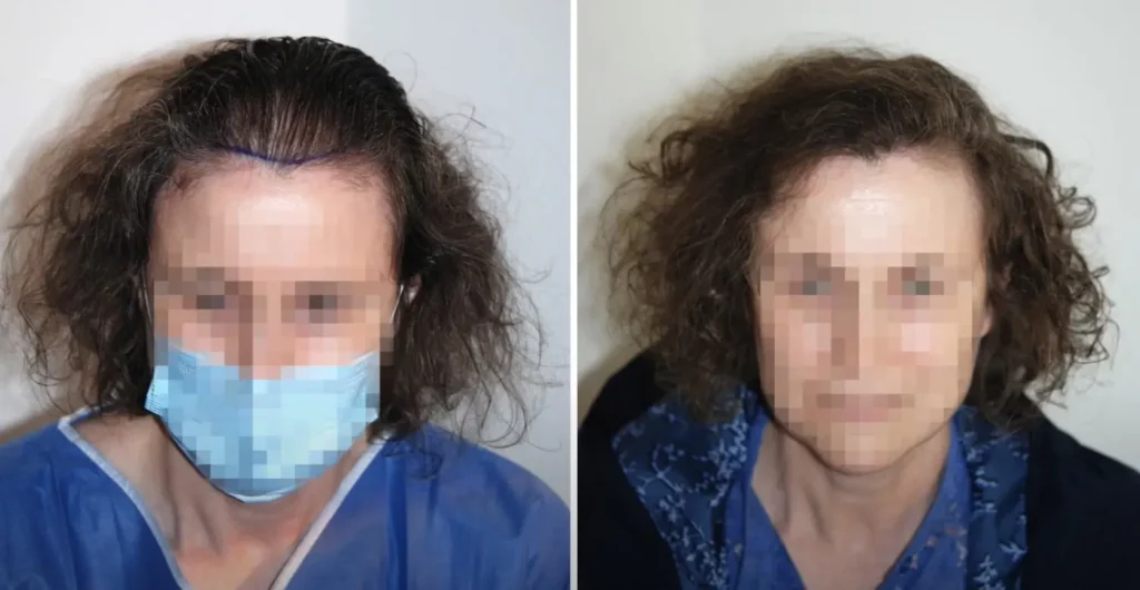 Frauen Haartransplantation Resultat und Vorher Nachher