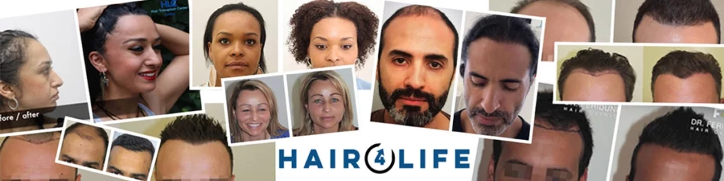 Haartransplantation Beratung Hairforlife