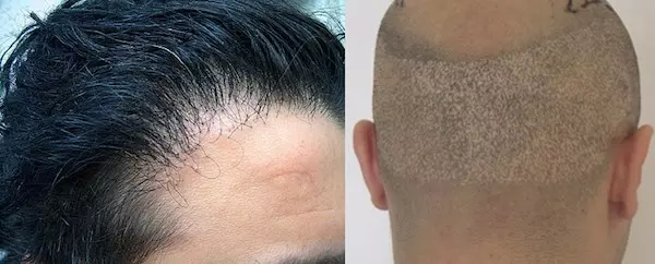 Risiken einer Haartransplantation und Erfolgsquote Risiken einer Haartransplantation und Erfolgsquote