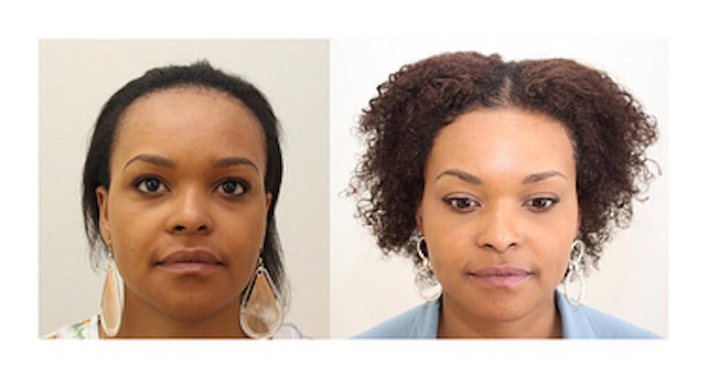 Haartransplantation Frauen Vorher Nachher 2766 Grafts Dr. Patrick Mwamba