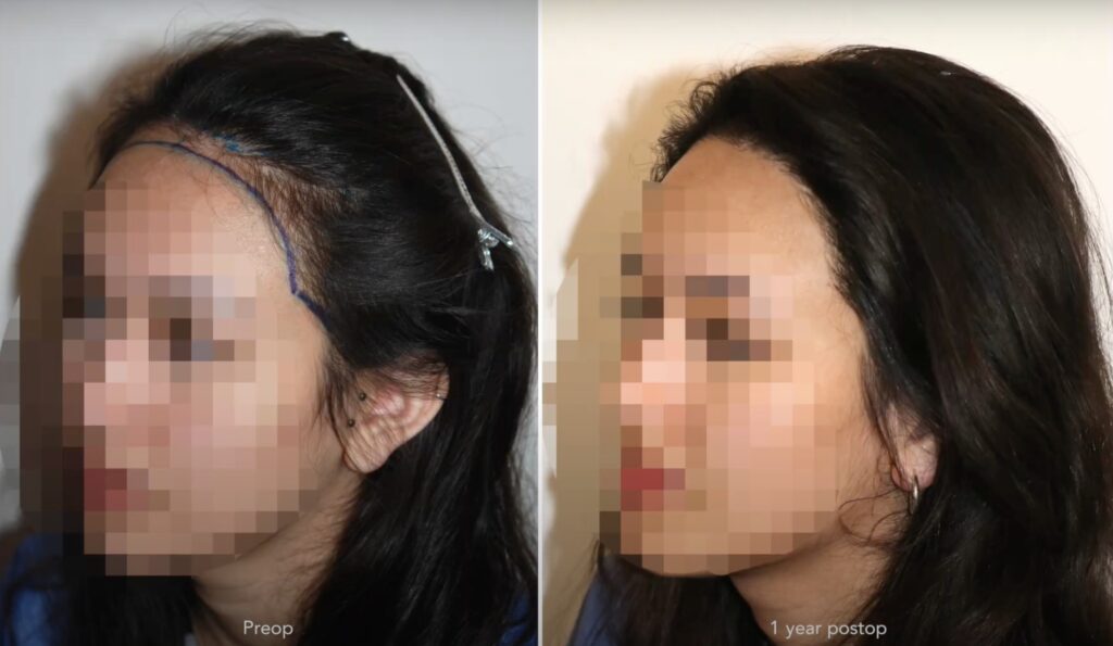 Haartransplantation Frauen Vorher Nachher Beispiel 2633 Grafts Dr. Feriduni