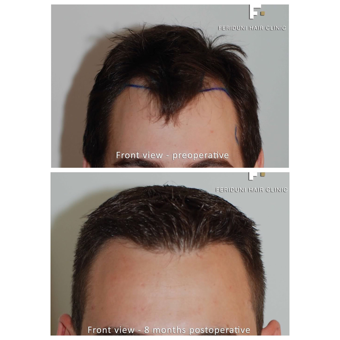 Haartransplantation Geheimratsecken Vorher Nachher 800 Grafts Dr. Bijan Feriduni