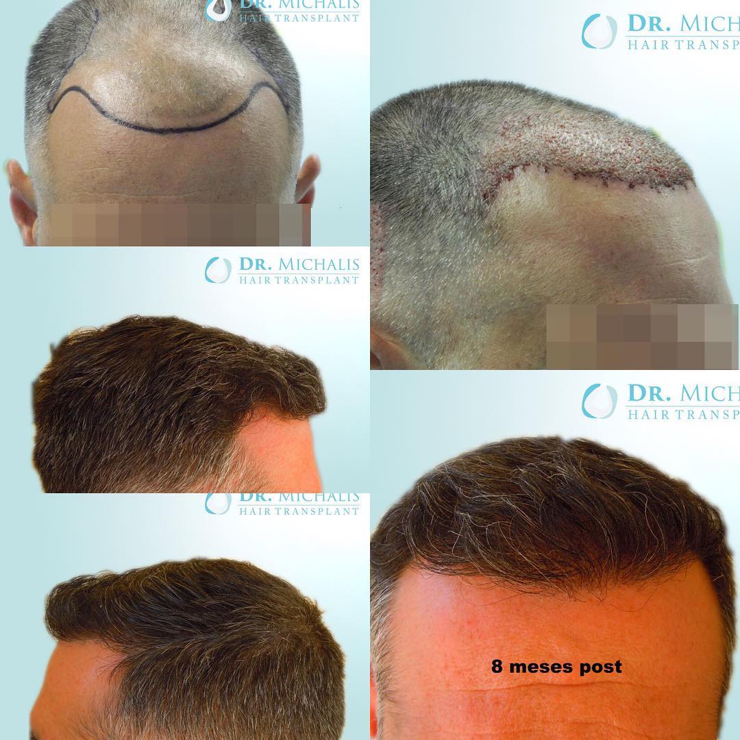 Haartransplantation Vorher Nachher Beispiel 2979 Grafts Dr. Michalis
