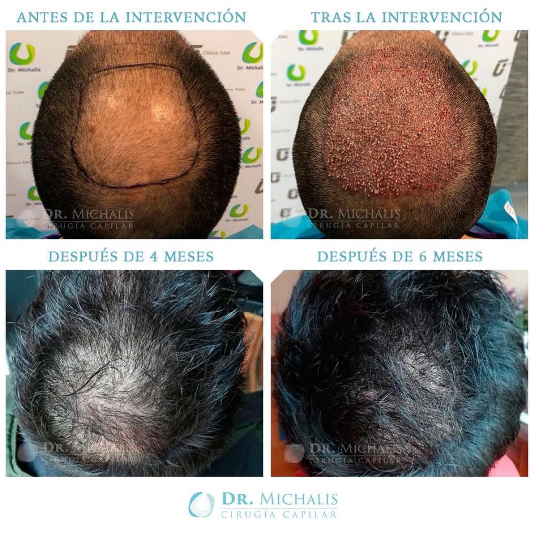 Haartransplantation Vorher Nachher Tonsur 3500 Grafts Dr. Michalis