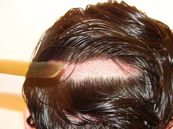FUE-Haartransplantation mit Streifenrasur