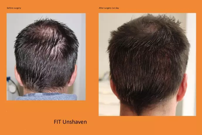 Unshaven-Technik-Haartransplantation ohne jegliche Rasur