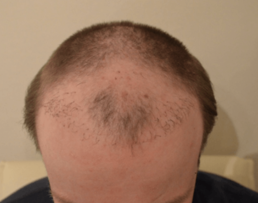 Verpfuschte schlechte Haartransplantation Beispiel misslungene Haar-OP