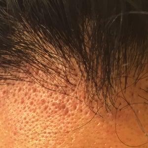 Narben im Empfangsgebiet Pitting nach Haartransplantation Realself