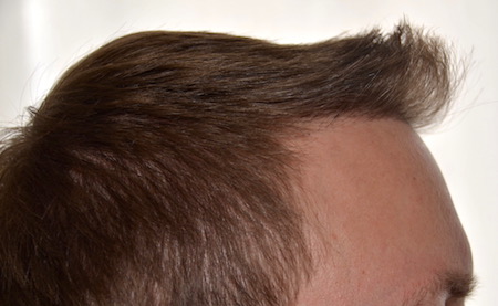 Haartransplantation Türkei schlechte Erfahrungen: Resultat der Korrektur von HLC Ansicht von rechts Haartransplantation Türkei Schlechte Erfahrungen Beispiel Korrektur von rechts