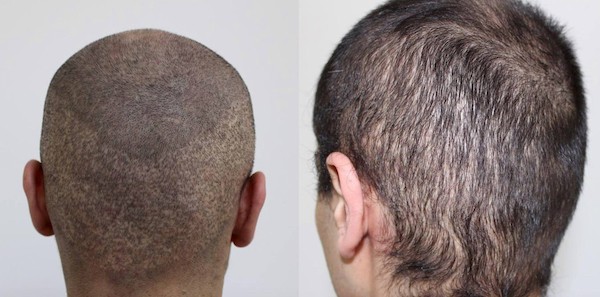 Haartransplantation Türkei Risiken im Haarkranz bei FUE Beispiel 1. Fenster- und Fussballfeldoptik und Mottenfrass