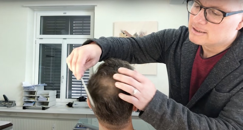 J. Hansens fortschreitender Haarausfall in der Tonsur - Haartransplantation zur Verdichtung ja oder nein
