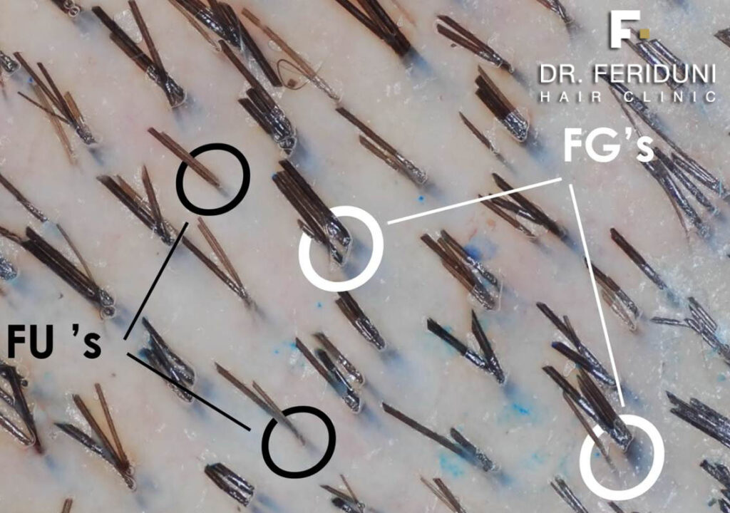 Haartransplantation wesentliche Kriterien: Follicular Units und Summe implantierte Haare