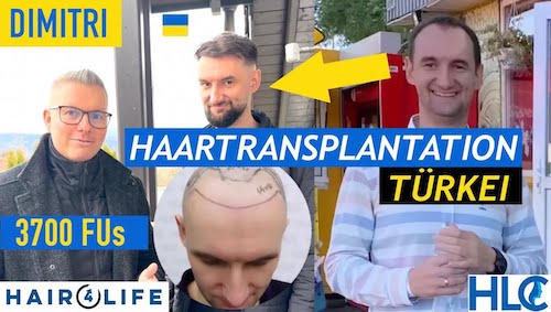 Haartransplantation Erfahrungsbericht Vorher Nachher Dimitri