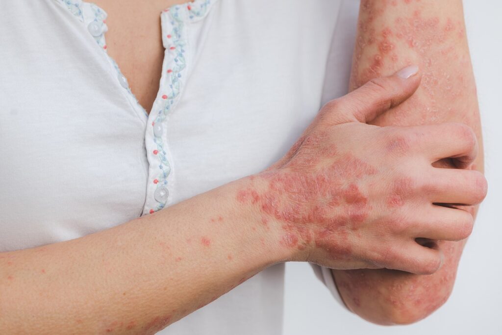Haartransplantation bei Schuppenflechte (Psoriasis)